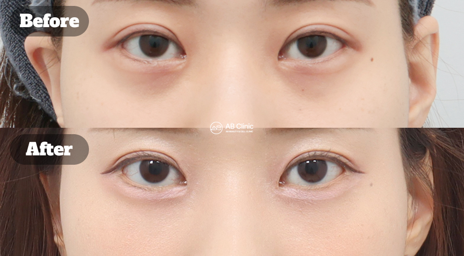 Before after skin booster treatment to improve dark circles and tired looking eyes
