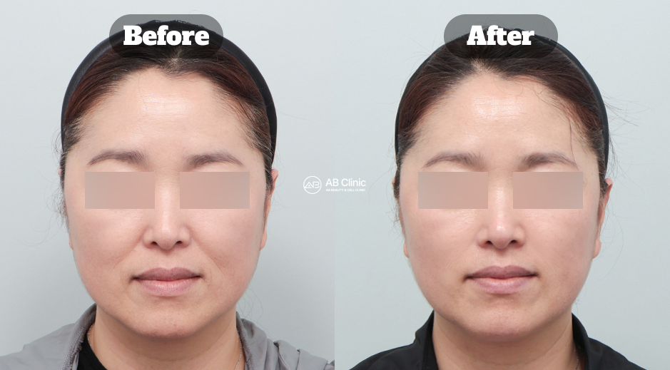 Perbandingan before after kombinasi Ultherapy, Shurink, dan Resnova Crystal di Korea untuk pengencangan kulit dan kontur wajah alami