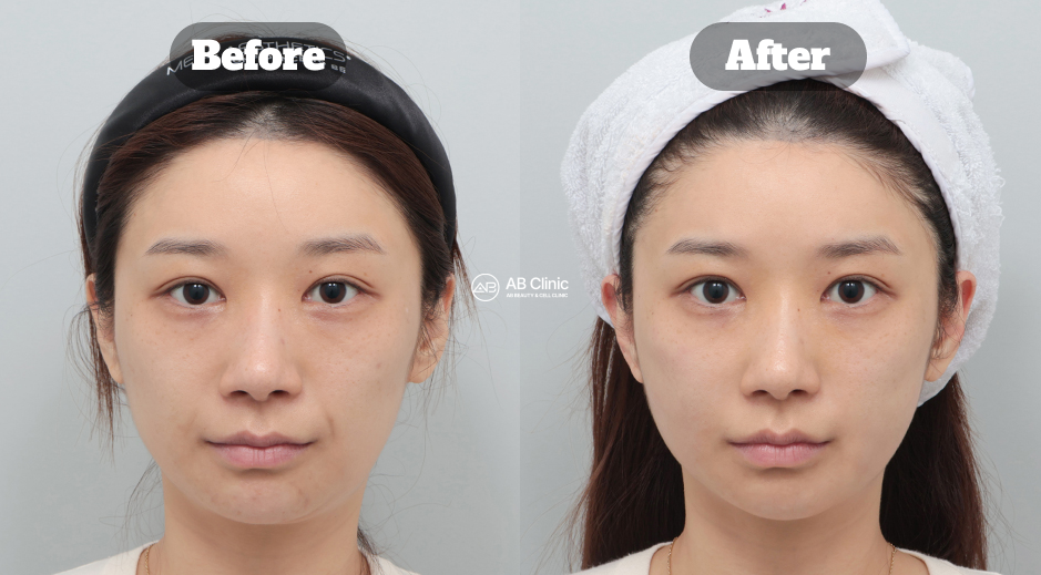 Before after Ulthera and Juvelook treatment for skin lifting and texture improvement