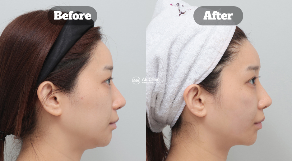 Perbandingan before after perawatan Ultherapy dan Juvelook di klinik dermatologi Korea untuk pengencangan dan kualitas kulit wajah